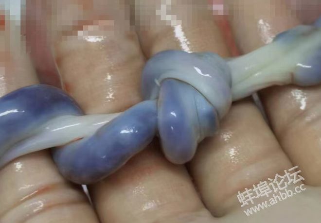 512护士节 “五花大绑”的宝娃躲过一“结”(图1)